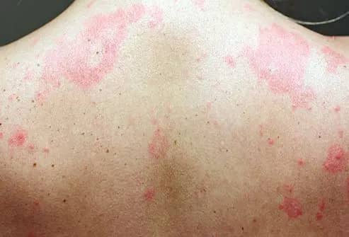 Aquagenic Pruritus: Itching without Rash
